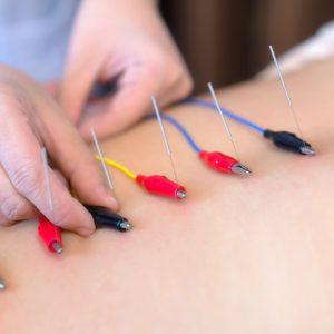 young woman undergoing acupuncture treatment at the health spa.